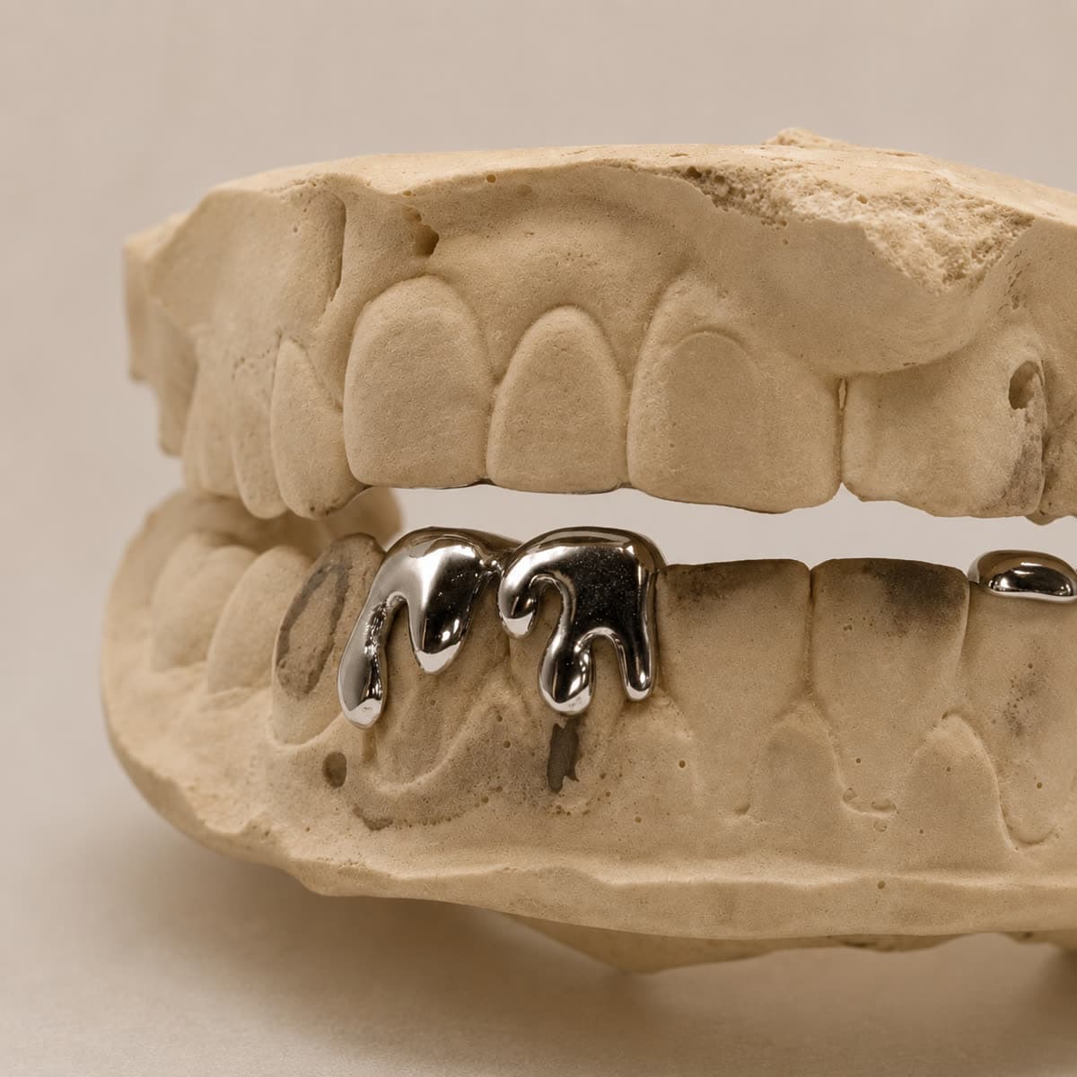 Grillz drip su misura in lega dentale lucidata, provato sul calco in gesso dei denti